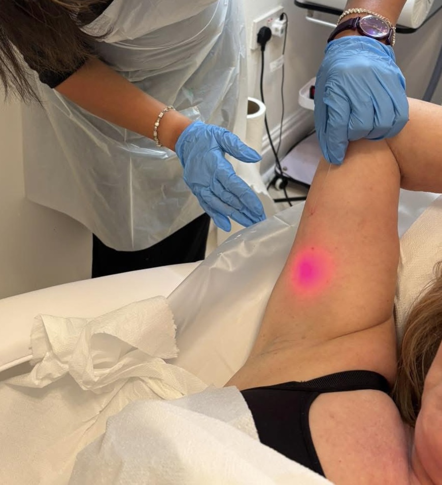 Endolift 3