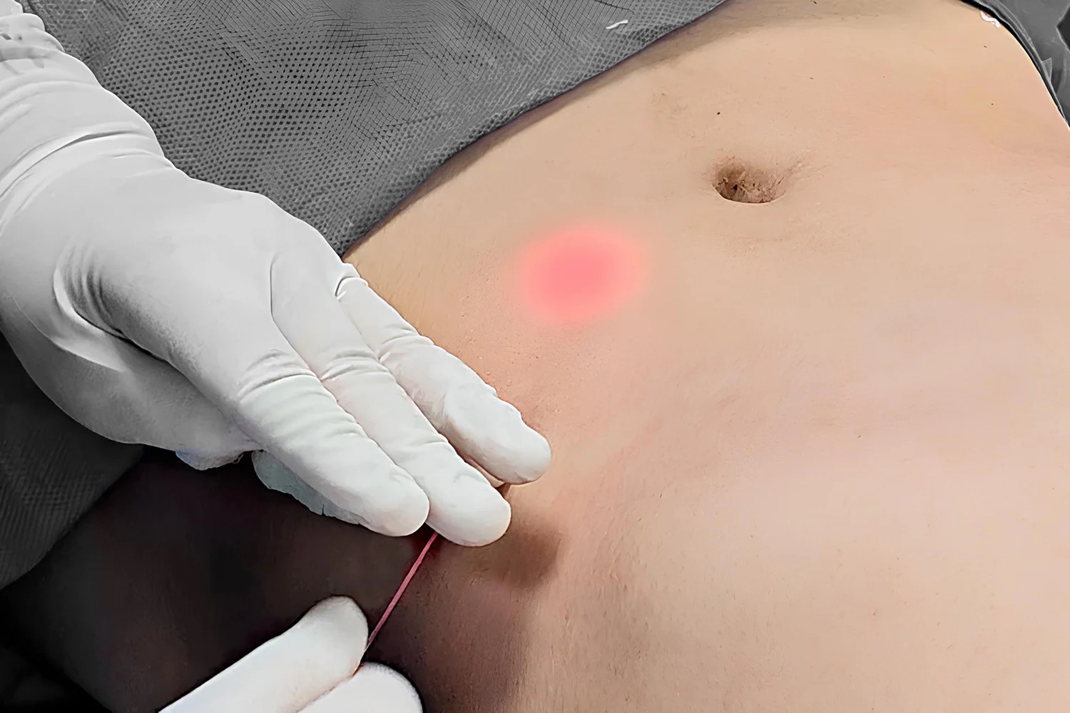 Endolift 4