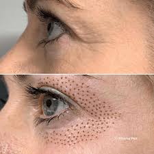 before and after plasma pen eye