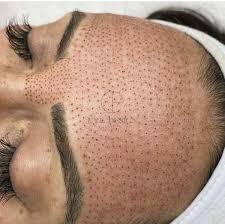 forehead plasma pen
