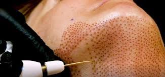 shoulder plasma pen